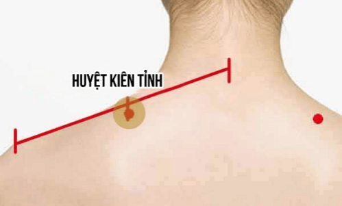 Xoa bóp khi bị vẹo cổ cấp tính
